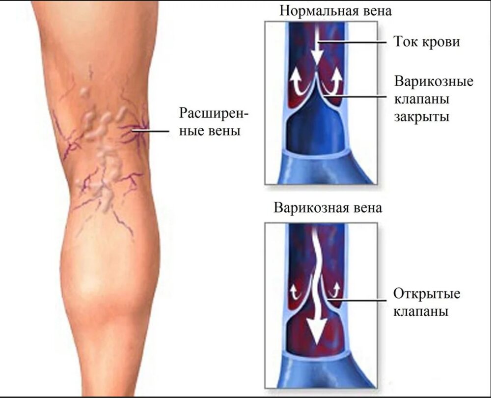 Вена осложнения